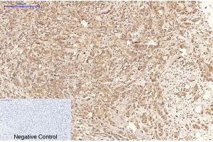 Immunohistochemical analysis of paraffin-embedded human breast cancer tissue. (MLKL anticorps  (pSer358))