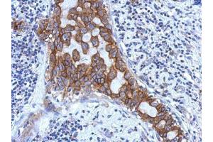 IHC-P Image Immunohistochemical analysis of paraffin-embedded human breast cancer, using IL1RAP, antibody at 1:500 dilution. (IL1RAP anticorps)