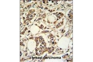PIGM Antibody (C-term) (ABIN650949 and ABIN2840006) IHC analysis in formalin fixed and paraffin embedded breast carcinoma followed by peroxidase conjugation of the secondary antibody and DAB staining. (PIGM anticorps  (C-Term))