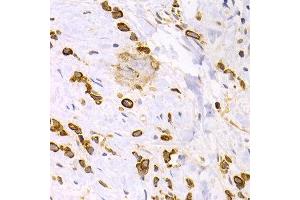 Immunohistochemistry of paraffin-embedded human stomach cancer using KRT15 antibody at dilution of 1:200 (400x lens). (KRT15 anticorps)