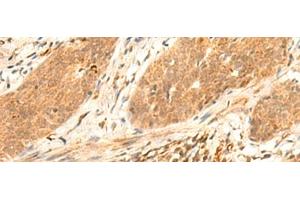 Immunohistochemistry of paraffin-embedded Human esophagus cancer tissue using HES7 Polyclonal Antibody at dilution of 1:25(x200) (HES7 anticorps)