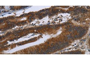 Immunohistochemistry of paraffin-embedded Human colon cancer tissue using ARHGEF12 Polyclonal Antibody at dilution 1:30