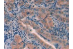 Detection of CTSL in Human Thyroid cancer Tissue using Polyclonal Antibody to Cathepsin L (CTSL)
