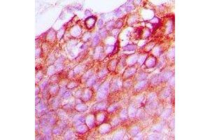 Immunohistochemical analysis of GPR170 staining in human breast cancer formalin fixed paraffin embedded tissue section. (OXER1 anticorps)