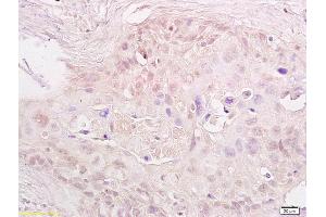 Formalin-fixed and paraffin embedded human cervical carcinoma labeled with Anti-MTA1 Polyclonal Antibody, Unconjugated (ABIN686182) at 1:600, followed by conjugation to the secondary antibody and DAB staining