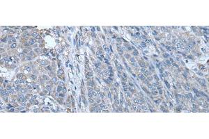 Immunohistochemistry of paraffin-embedded Human liver cancer tissue using ZC3HAV1 Polyclonal Antibody at dilution of 1:70(x200) (ZC3HAV1 anticorps)