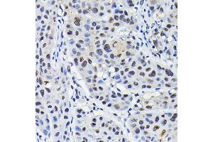 Immunohistochemistry of paraffin-embedded human esophageal cancer using KPN Rabbit pAb (ABIN6131812, ABIN6142991, ABIN6142992 and ABIN6224371) at dilution of 1:100 (40x lens).