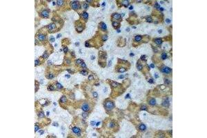 Immunohistochemical analysis of HADHA staining in human liver cancer formalin fixed paraffin embedded tissue section.