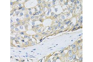 Immunohistochemistry of paraffin-embedded Human breast cancer using CD98 Polyclonal Antibody at dilution of 1:100 (40x lens). (SLC3A2 anticorps)