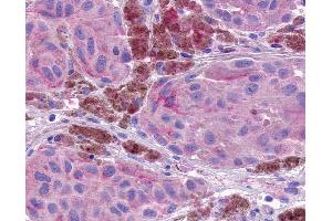 Anti-NPBWR1 / GPR7 antibody IHC of human Skin, Melanoma. (NPBWR1 anticorps  (Extracellular Domain))