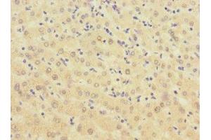 Immunohistochemistry of paraffin-embedded human liver cancer using ABIN7145876 at dilution of 1:100 (BTN1A1 anticorps  (AA 27-210))