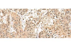 Immunohistochemistry of paraffin-embedded Human prost ate cancer tissue using NCAPH Polyclonal Antibody at dilution of 1:45(x200) (NCAPH anticorps)