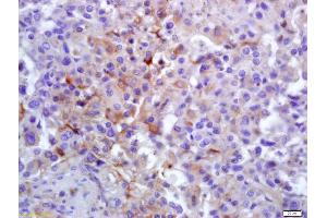 Formalin-fixed and paraffin embedded human lung carcinoma labeled with Anti-PLK1 Polyclonal Antibody, Unconjugated (ABIN700435) at 1:200 followed by conjugation to the secondary antibody and DAB staining (PLK1 anticorps  (AA 201-300))
