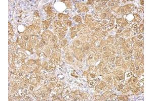 IHC-P Image Aldolase B antibody detects ALDOB protein at cytosol on human hepatoma by immunohistochemical analysis.