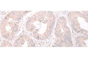 Immunohistochemistry of paraffin-embedded Human colorectal cancer tissue using FOXRED2 Polyclonal Antibody at dilution of 1:35(x200) (FOXRED2 anticorps)