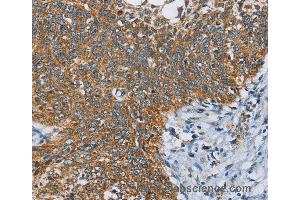 Immunohistochemistry of Human thyroid cancer using ANKHD1 Polyclonal Antibody at dilution of 1:40 (ANKHD1 anticorps)