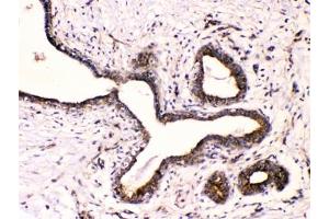 IHC testing of FFPE human breast cancer with Beta III Tubulin antibody at 1ug/ml.