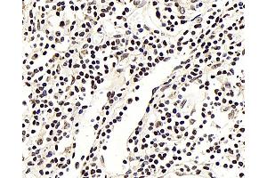 Immunohistochemistry analysis of paraffin-embedded human lung cancer using NFKBIB Polyclonal Antibody at dilution of 1:300.