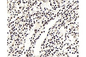 Immunohistochemistry analysis of paraffin-embedded human lung cancer using NFKBIB Polyclonal Antibody at dilution of 1:300. (NFKBIB anticorps)