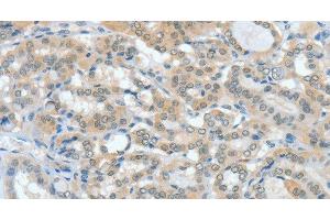 Immunohistochemistry of paraffin-embedded Human thyroid cancer tissue using ASH2L Polyclonal Antibody at dilution 1:60 (ASH2L anticorps)