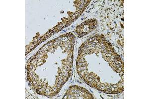 Immunohistochemistry of paraffin-embedded human prostate using UQCRC1 antibody (ABIN5971722) at dilution of 1/100 (40x lens). (UQCRC1 anticorps)