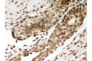 Anti- Lamin A Picoband antibody, IHC(P) IHC(P): Human Mammary Cancer Tissue