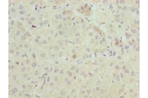 Immunohistochemistry of paraffin-embedded human liver cancer using ABIN7151560 at dilution of 1:100 (ELOVL2 anticorps  (AA 91-174))