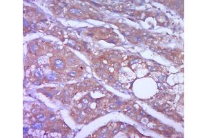 Paraformaldehyde-fixed, paraffin embedded human liver carcinoma; Antigen retrieval by boiling in sodium citrate buffer (pH6.