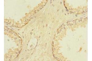 Immunohistochemistry of paraffin-embedded human prostate cancer using ABIN7175634 at dilution of 1:100 (VN1R5 anticorps  (AA 185-269))