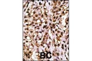 Formalin-fixed and paraffin-embedded human cancer tissue reacted with the primary antibody, which was peroxidase-conjugated to the secondary antibody, followed by DAB staining. (ATG4A anticorps  (AA 363-392))
