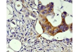 Immunohistochemical analysis of paraffin-embedded human colon carcinome, using GSK3 beta Antibody. (Recombinant GSK3 beta anticorps)