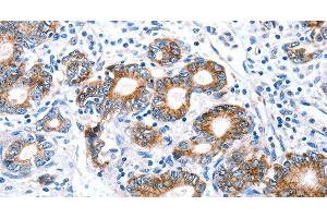 Immunohistochemistry of paraffin-embedded Human stomach cancer using Claudin 7 Polyclonal Antibody at dilution of 1:50 (Claudin 7 anticorps)