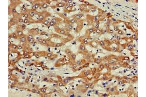 Immunohistochemistry of paraffin-embedded human liver cancer using ABIN7163167 at dilution of 1:100 (PIK3R2 anticorps  (Regulatory Subunit beta))
