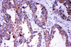 Anti- DISC1 antibody, IHC(P): Human Lung Cancer Tissue (DISC1 anticorps  (Middle Region))