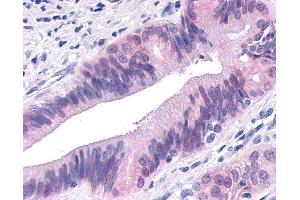Anti-TNIK antibody IHC of human Pancreas, Carcinoma. (TNIK anticorps  (Internal Region))
