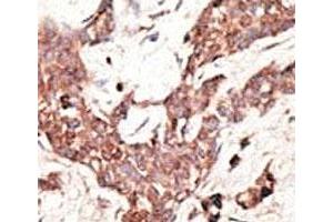 IHC analysis of FFPE human breast carcinoma tissue stained with the SIRT3 antibody