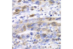 Immunohistochemistry of paraffin-embedded human gastric cancer using UBE2C antibody (ABIN5973207) at dilution of 1/100 (40x lens). (UBE2C anticorps)