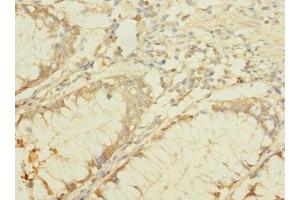 Immunohistochemistry of paraffin-embedded human colon cancer using ABIN7145384 at dilution of 1:100 (B4GALNT2 anticorps  (AA 301-566))