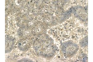 eIF4G1 Mouse Monoclonal Antibody at 1/100 staining human colorectal cancer by IHC-P.