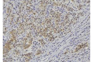 ABIN6278844 at 1/100 staining Human lung cancer tissue by IHC-P. (CRLF1 anticorps)