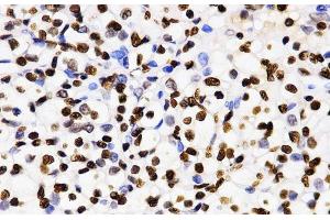 Immunohistochemistry of paraffin-embedded Human kidney cancer using DiMethyl-Histone H3-K4 Polyclonal Antibody at dilution of 1:200 (40x lens). (Histone 3 anticorps  (2meLys4))