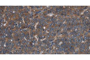 Immunohistochemistry of paraffin-embedded Human ovarian cancer tissue using LETMD1 Polyclonal Antibody at dilution 1:30 (LETMD1 anticorps)