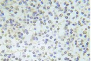Immunohistochemistry (IHC) analyzes of p-Abl1 antibody in paraffin-embedded human breast carcinoma tissue. (ABL1 anticorps  (pTyr204))
