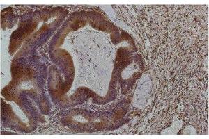 Immunohistochemistry of paraffin-embedded Human colon carcinoma tissue using Smad3 Monoclonal Antibody at dilution of 1:200. (SMAD3 anticorps)