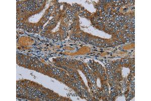 Immunohistochemistry of Human colon cancer using PCK2 Polyclonal Antibody at dilution of 1:60 (PEPCK anticorps)