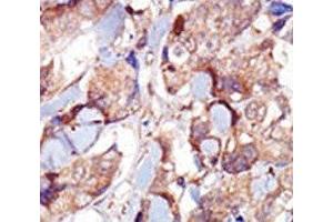 IHC analysis of FFPE human breast carcinoma tissue stained with the MYLK3 antibody