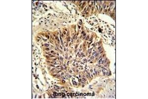 Formalin-fixed and paraffin-embedded human lung carcinoma with GOLPH3 Antibody (C-term), which was peroxidase-conjugated to the secondary antibody, followed by DAB staining. (GOLPH3 anticorps  (C-Term))