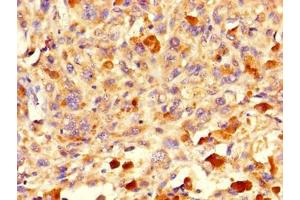 Immunohistochemistry of paraffin-embedded human melanoma using ABIN7162869 at dilution of 1:100 (Peptidyl-tRNA Hydrolase ICT1, Mitochondrial (AA 30-206) anticorps)