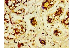 IHC image of ABIN7158571 diluted at 1:600 and staining in paraffin-embedded human breast cancer performed on a Leica BondTM system. (LRP2 anticorps  (AA 202-332))