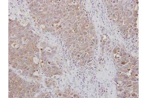 IHC-P Image Immunohistochemical analysis of paraffin-embedded AdCA xenograft, using RPL3, antibody at 1:100 dilution.